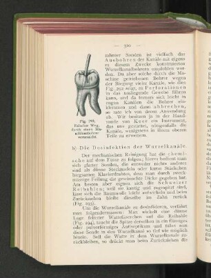 b) Die Desinfektion der Wurzelkanäle.