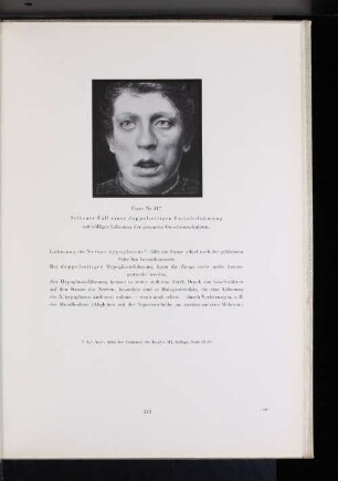 Figur Nr. 417 Seltener Fall einer doppelseitigen Facialislähmung mit völliger Lähmung der gesamten Gesichtsmuskulatur.