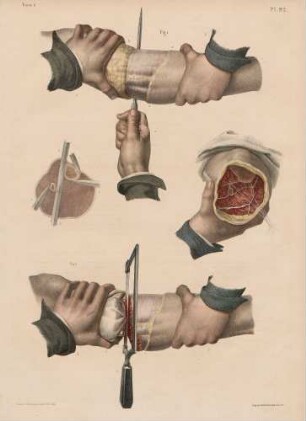 Amputation am Bein