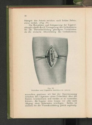 Fig. 39. Zwischen zwei Ligaturen durchtrennte Arterie.