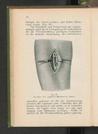 Fig. 39. Zwischen zwei Ligaturen durchtrennte Arterie.