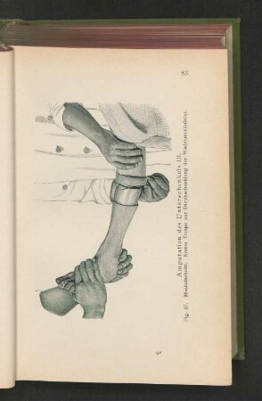 Fig. 57. Amputation des Unterschenkels III. Muskelschnitt. Erstes Tempo zur Durchschneidung der Wadenmuskulatur.