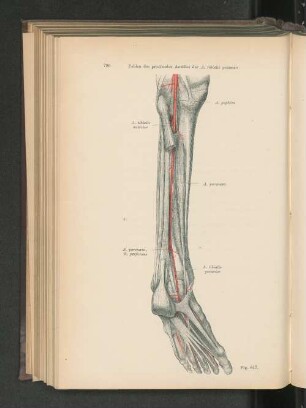 Fig. 617. Fehlen des proximalen ANteiles der A. tibialis posterior.