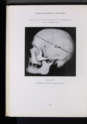 Knochenmarkentzündung = Osteomyelitis