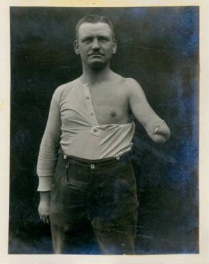 Foto eines Mannes mit amputiertem Unterarm, in dem er ein erstes Bauteil zur Anfertigung seiner Prothese trägt, im Kngl. Reservelazarett in Singen