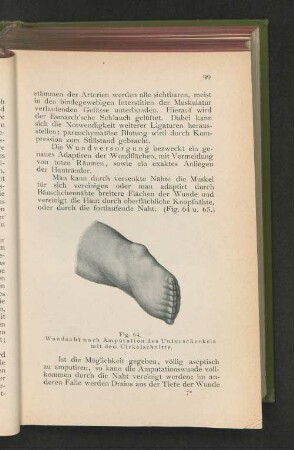 Fig. 64. Wundnaht nach Amputation des Unterschenkels mit dem Cirkelschnitte.