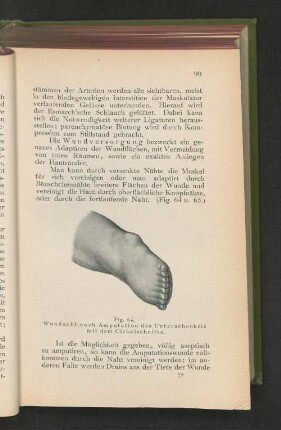 Fig. 64. Wundnaht nach Amputation des Unterschenkels mit dem Cirkelschnitte.