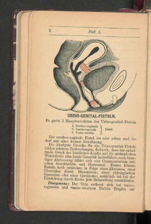 Urino-Genital-Fisteln.