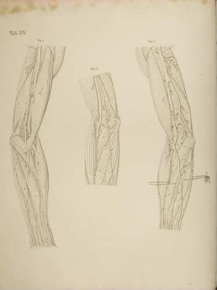 Beispiele von Anomalien im Arterienverlauf der Arme (Lineartafel)