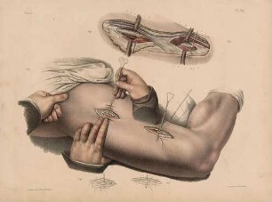 Ligatur der Femoralarterie