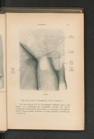 Fig. 478. Äußere Leistenhernie, Fascia cremasterica.