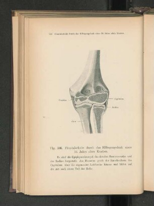 Fig. 566. Frontalschnitt durch das Ellenbogengelenk eines 14 Jahre alten Knaben.