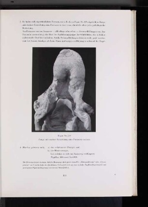 Figur Nr. 219 Zunge mit starker Einziehung zum Foramen caecum.