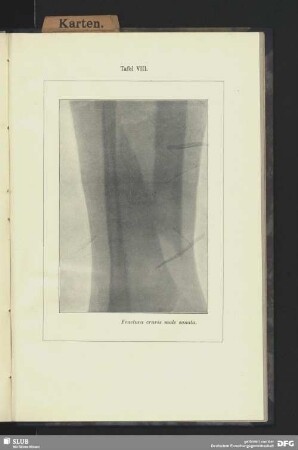 Tafel VIII. Fractura cruris male sanata