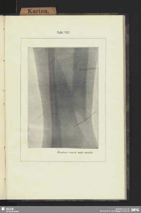 Tafel VIII. Fractura cruris male sanata