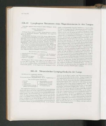 Abb. 66 Metastatischer Lymphgefässkrebs der Lunge