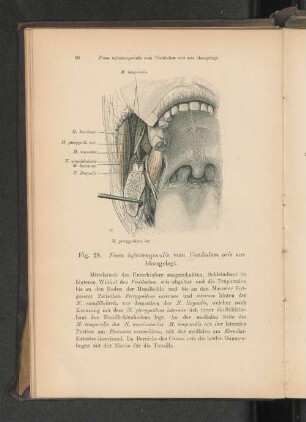 Fig. 28. Fossa infratemporalis vom Vestibulum oris aus blossgelegt.