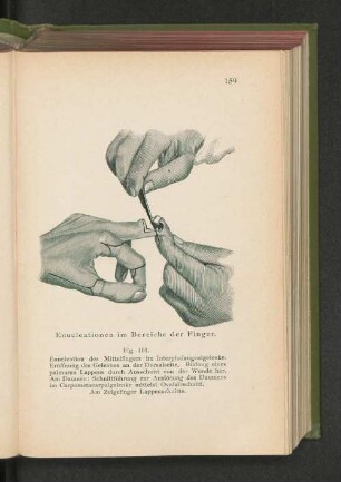 Fig. 101. Enucleationen im Bereiche der Finger.