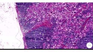 Clinical Pathology: Reactive lymph node