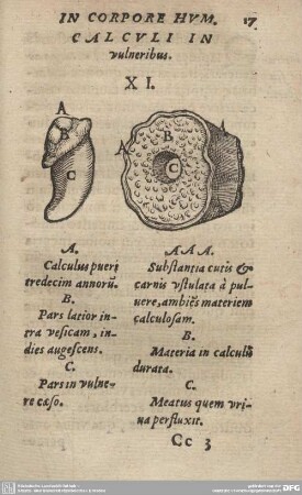 CALCULI In vulneribus XI.