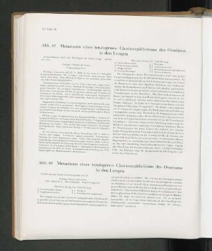 Abb. 68 Metastasen eines teratogenen Chorionepithelioms des Ovariums in den Lungen