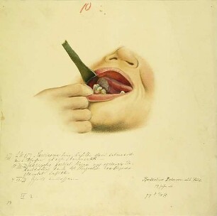 Carcinoma ling. Krankenbildnis Bertheline Petersen
