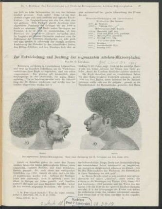 Zur Entwicklung und Deutung der sogenannten Azteken-Mikrocephalen.