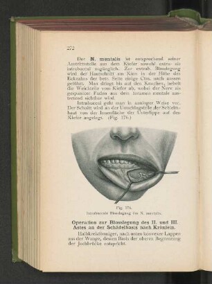 Der N. Mentalis.