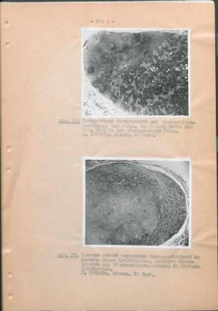 Abb. 22: Hochgradige Sinuskatarrh und Plasmazellenvermehrung der Pulpa.