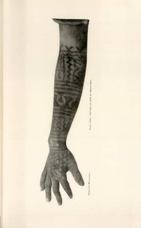 Plate LXXV. Tattoo on arm of Ibaloi girl