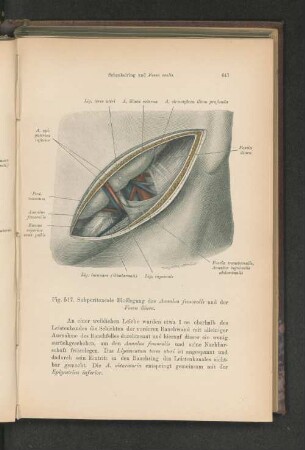 Fig. 517. Subperitoneale Bloßlegung des Annulus femoralis und der Fossa iliaca.
