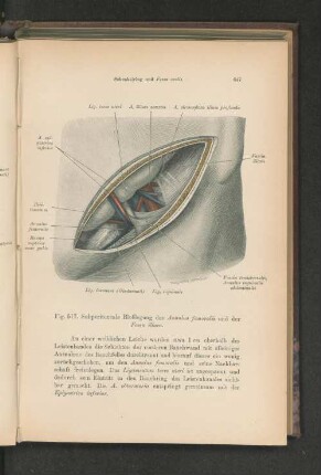 Fig. 517. Subperitoneale Bloßlegung des Annulus femoralis und der Fossa iliaca.
